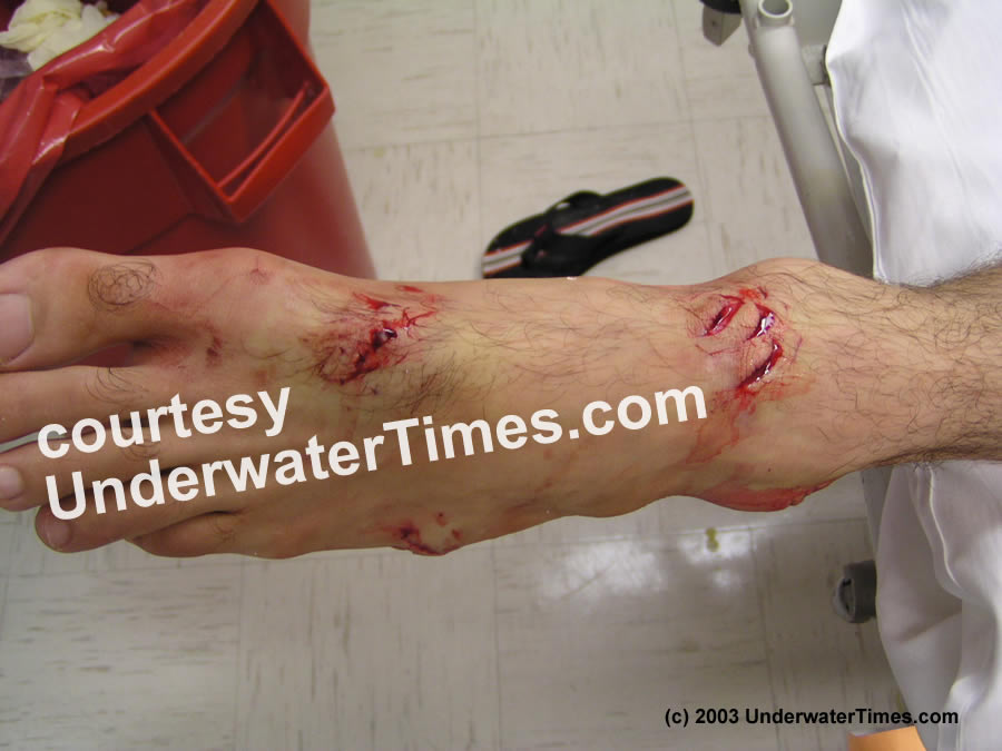 Photos from shark attack on Jimmy Arnold