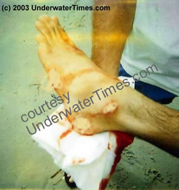 shark attacks in florida. shark attack wound foot New