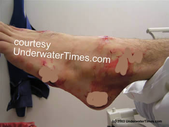 shark attack wound foot New Smyrna 4