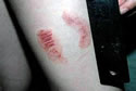 fishbite